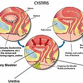 Cystitis (UTI), Bladder Infection Â· NYC Pelvic Doctor