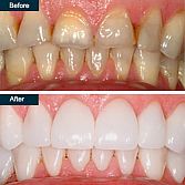 Dental Crown, Teeth Crowns