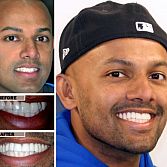 Dental Veneers (Porcelain Veneers Teeth, Press on Veneers) â Cosmetic Dentist in Brooklyn, NY
