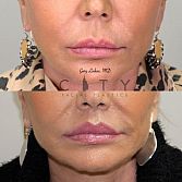 Elelyft - New York Facial Plastic Surgeon Dr. Gary Linkov