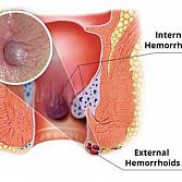 Hemorrhoids Treatment from Manhattan Gastroenterology