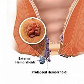 Hemorrhoids Treatment from Manhattan Gastroenterology