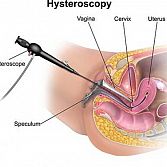 Hysteroscopy Procedure Â· Uterine Polyp Removal in Midtown Manhattan NYC