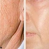 Laser Skin Resurfacing in NYC | Top Skin Rejuvenation Clinic in Midtown New York