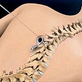 Minimally Invasive Spine Surgery in NYC