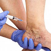 Sclerotherapy for Varicose Veins from Varicose Vein Treatments Center