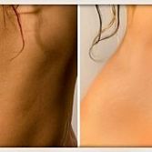 Stretch Mark Removal in NYC, Laser Treatment Specialist, Midtown Manhattan