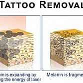 Tattoo Removal Â· Dermatologist Â· Cosmetic, Laser Dermatology NYC