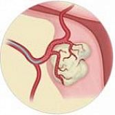 Uterine Fibroid Embolization (UFE) â Top Fibroids Doctors and Specialists