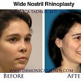 Wide Nostril Reduction And Big Nostril Nose Job In NYC & NJ
