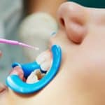 Dental Sealants for Kids and Teens: Protecting Smiles