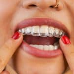 Invisalign Invisible Braces with Custom Treatment Plans
