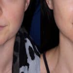 Lip Lift Revision Surgeon: Expertise for Perfect Results