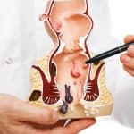 Hemorrhoids Treatment from Manhattan Gastroenterology