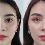 Wide Nostril Reduction & Big Nostril Nose Job In NYC & NJ