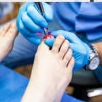 Fast and Effective Toenail Fungus Laser Treatment