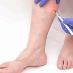 Say Goodbye to Varicose Veins with Ambulatory Phlebotomy