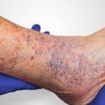Advanced Treatments for Venous stasis Ulcers