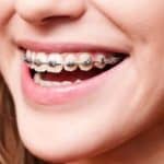 Braces Retainers: Essential Tips for Maintaining Smile