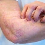 A Deep Dive into Allergies: Understanding Symptoms