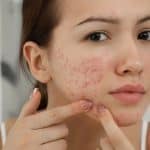 Managing Acne: From Mild to Severe Breakouts