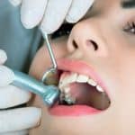 Affordable Single Tooth Implants in NYC
