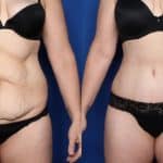 What Is a Tummy Tuck or Abdominoplasty?
