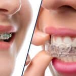 Traditional Braces vs. Invisalign: Which Is Right for You?