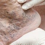 Venous Stasis Ulcer Healing in Brooklyn, NY