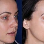 Elelyft – New York Facial Plastic Surgeon Dr. Gary Linkov